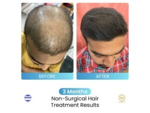 Dr. Stuti Khare Shukla’s Non-Surgical Hair Growth Booster helping multiple people suffering from Hair Loss Issues