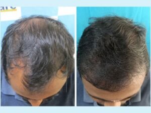 VCare’s Hair Transplantation Ensures To Completely Reverse Baldness